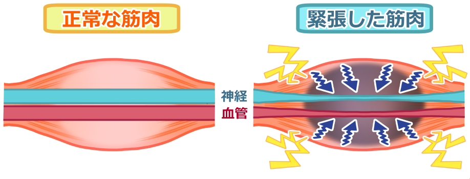 正常な筋肉と緊張した筋肉